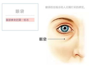 苏大强的眼袋 对眼睛有5大潜在危害