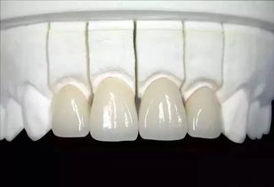 格莱美全瓷牙冠是哪个国家的,格莱美全磁牙冠:起源与技术