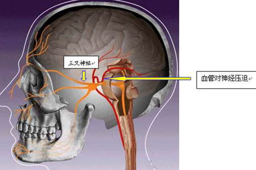 吴济堂 三叉神经痛是什么引起的,与这5种原因密切相关