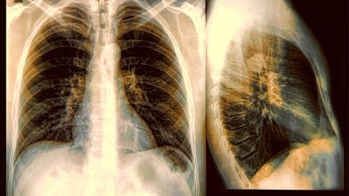 肺癌照片图片大全图片