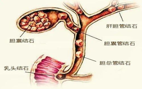 秋冬易发作的胆结石,也能艾灸调理 这些配穴你知道吗