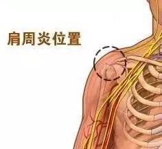 专家揭秘 9成肩周炎患者不用手术 1分钟学会3个方法轻松根治 