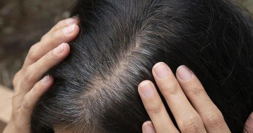 白头发 可能预示着这些疾病 5个因素导致长白发
