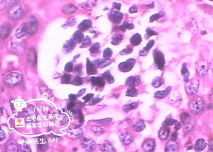 细菌性阴炎对胎儿 妇科细菌性阴炎症状 细菌性阴炎怎么得的 