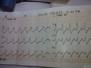 这心电图,看起来挺怕的 高手分析下啊 心血管专业讨论版 