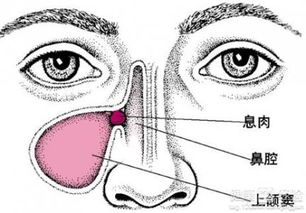 鼻息肉是如何生成的