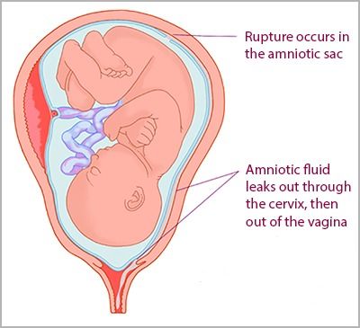 胎膜早破是什么症状