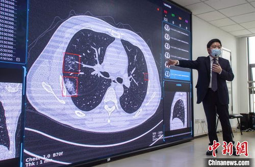 四川研发 肺部多病变CT影像AI筛查与辅助诊断系统