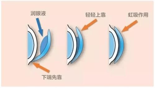 角膜塑形镜和现在的中医视力理疗矫正，效果有啥区别(角膜塑形镜是物理治疗吗)