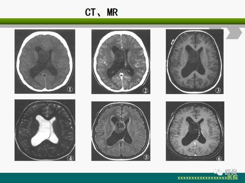 脑室内室管膜瘤的影像诊断及鉴别 医学影像经典PPT 