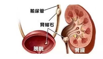 肾结石是不可以喝牛奶吗