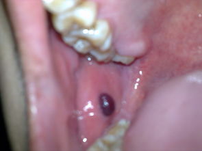 口腔内壁长了个血泡 