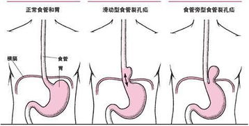 冬天寒冷,常吃火锅易致食道裂开 警告 再好吃也不要贪嘴 