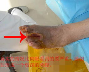 云南糖尿病人脚被暖风扇烧伤截趾后伤口感染