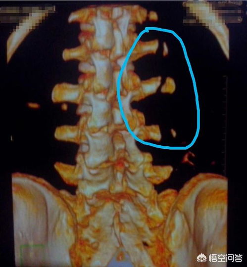腰椎横突骨折图片 搜狗图片搜索