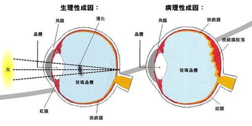 眼睛看到有黑点漂浮物,到底是什么原因 上海和平眼科告诉你