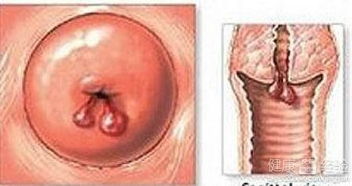 宫颈息肉要开刀吗(宫颈息肉要开刀吗要住院吗)