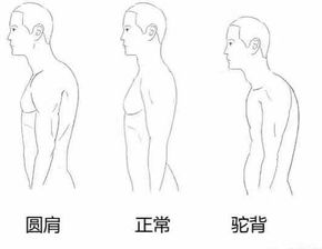 圆肩驼背怎么矫正 圆肩驼背对形象的影响