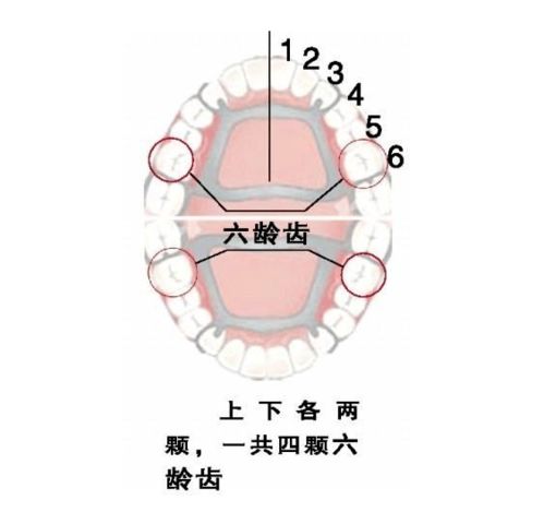 窝沟封闭,预防儿童龋齿