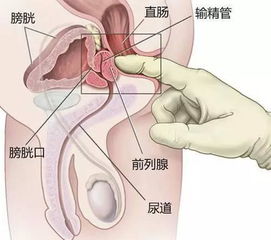 手把手教你看懂检查报告 前列腺液常规 