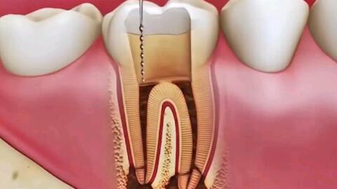 我们都说给牙齿龋坏可能需要做根管治疗,到底什么是根管治疗 哪些牙齿问题需要做根管治疗呢
