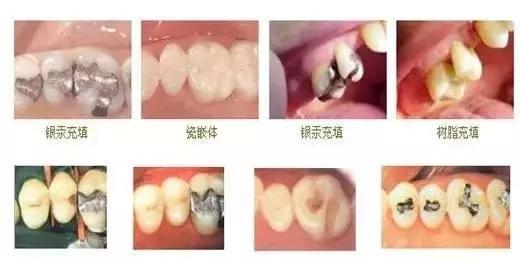 揭秘补牙全过程 你的牙齿到底经历了什么