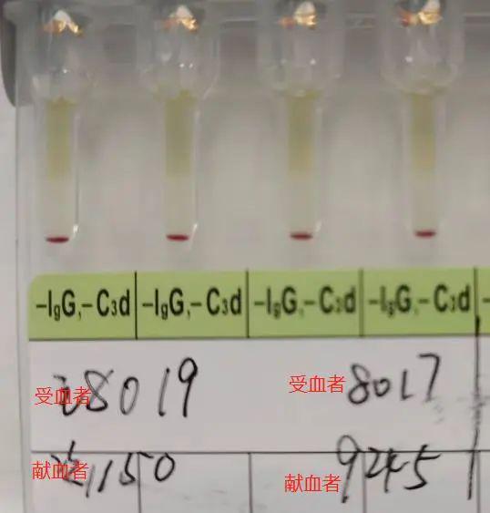 交叉配血主侧不凝次侧凝,原因是