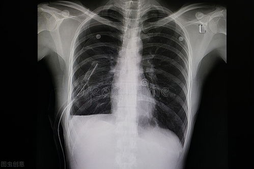 引起胸腔积液的3类疾病要警惕