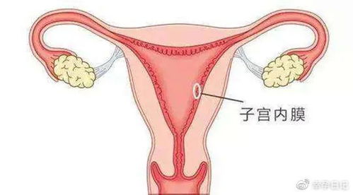 子宫内膜是胚胎着床的地方，试管助孕该怎么办？