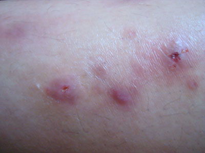 梅毒第三针特别疼图片