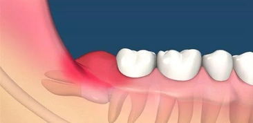 智齿一定要拔吗 智齿有哪些危害