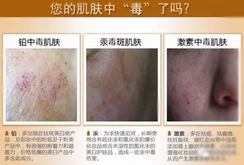 惊悚的 铅汞 揭秘皮肤怎么就敏感起来了呢