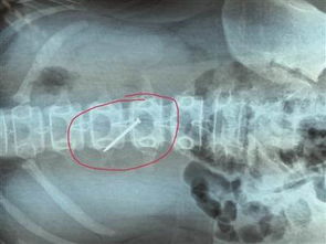 江苏13岁女孩吞下4厘米铁钉 钉子穿过胃壁危及生命