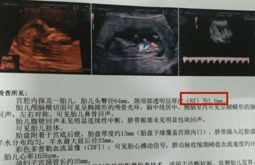 原创孕期，B超单上的这3个信息，或许表示怀了个可爱的“小帅哥”
