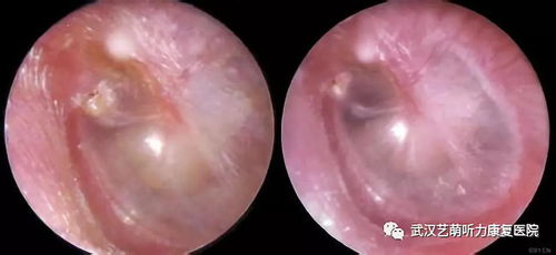 OMG ,中耳炎不治疗,可能发展成耳聋