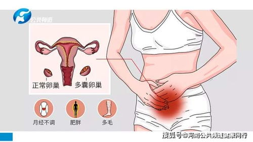 多囊卵巢综合征的临床表现有 多囊卵巢综合征的临床表现有哪些