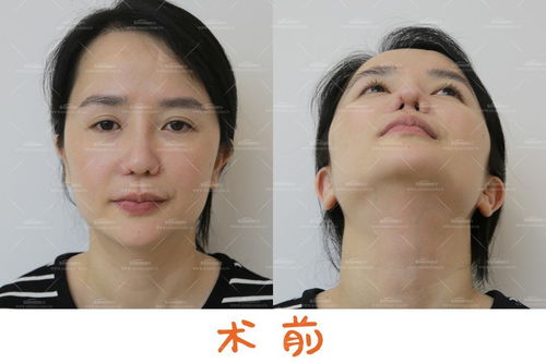 鼻修复案例 鼻翼切除过多,该如何修复