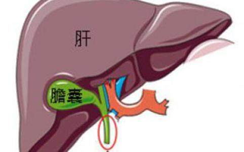 胆囊炎的常见信号,莫不可与胃病混淆 患有胆囊炎的都看看