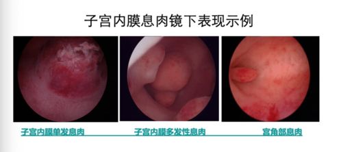 腹部没有刀口的宫腔镜是何路神仙