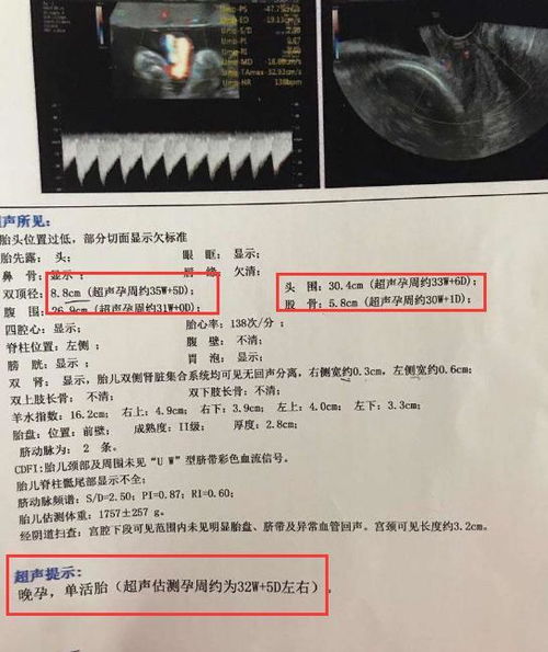 初次怀孕一般什么时候生,预产期前还是后 二胎妈妈述经历