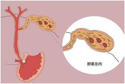 胆囊息肉不能吃哪些食物