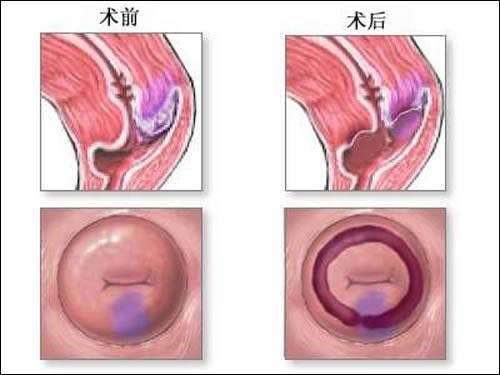 宫颈糜烂的护理措施有哪些？