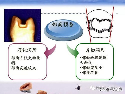 关于嵌体修复的基础入门知识 