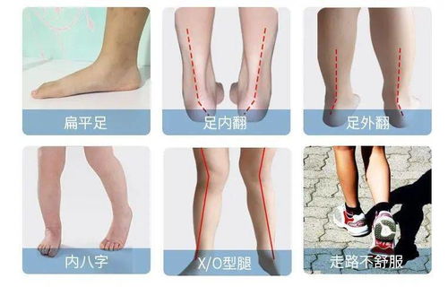 关注儿童足部发育规律 家长稍不留意都会导致孩子足部骨骼出现畸形