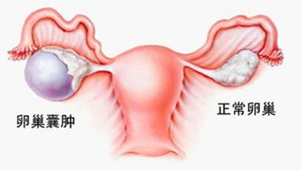 卵巢囊肿右边腹部疼痛