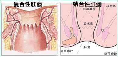 肛瘘的症状是什么 