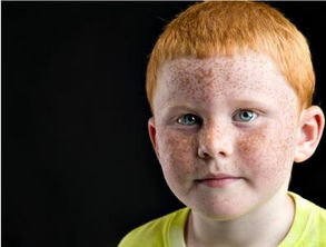 儿童脸上长雀斑是什么原因(小孩儿脸上长雀斑是什么原因?)