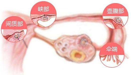 生化妊娠是因为输卵管堵塞吗,是因为输卵管吗?生物学上的怀孕
