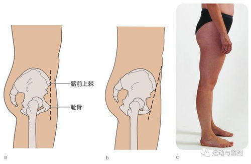 盆骨前倾平时应该怎么调整,骨盆前倾，日
