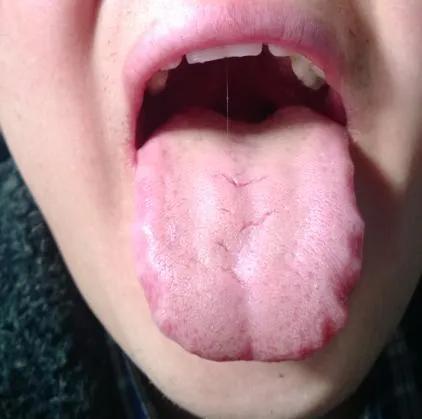 舌头上的 齿印 ,代表着什么 三印诊法 完结版